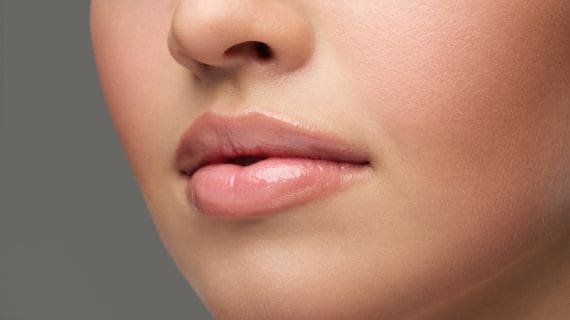 Dermal Fillers treatment at Calgary MediSpa