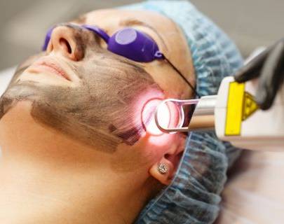 Carbon Laser Facial